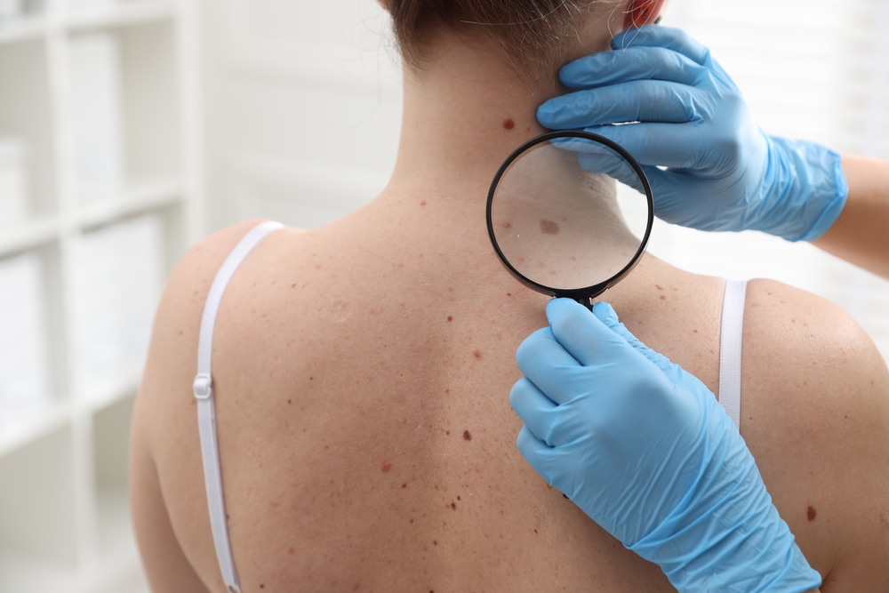 Doctor checking skin mole