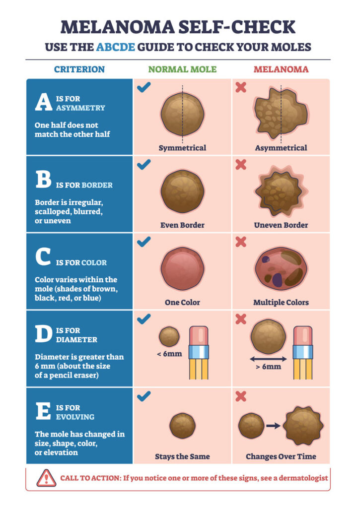 Melanoma self-check chart