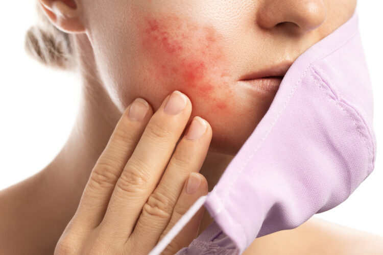 Young woman's face with Rosacea